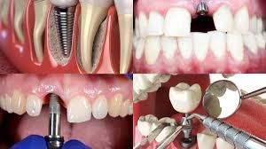 4 Signs You Might Be A Candidate For Implant Dentistry